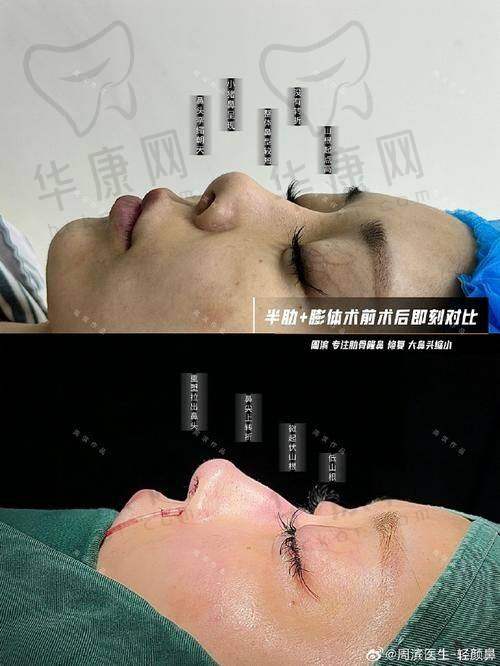 深圳王天国做桃花鼻靠谱吗？从隆鼻优势及审美看效果与口碑如何
