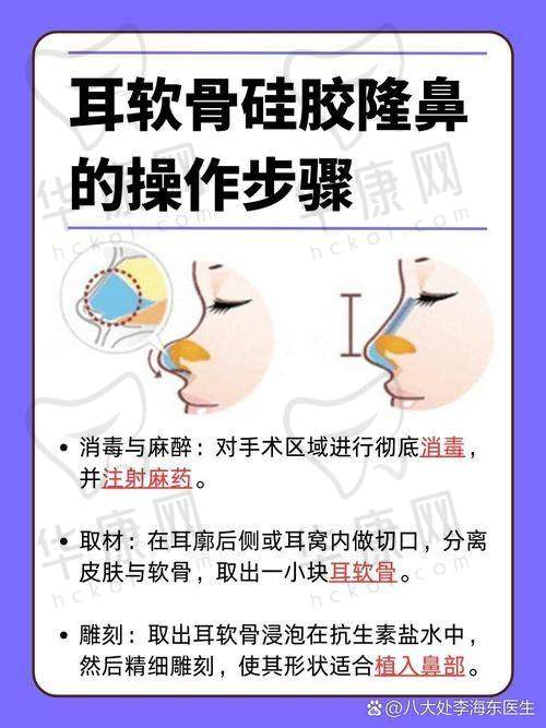 广州美莱医疗美容医院廖轶平鼻部整形20000元起，打造自然持久、立体精致美鼻！