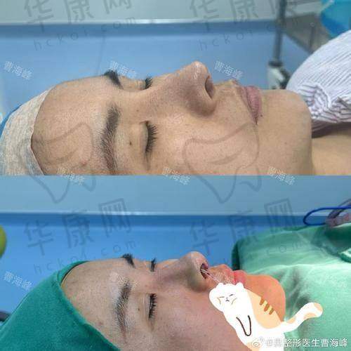 广州美莱医疗美容医院廖轶平鼻部整形的成功实例