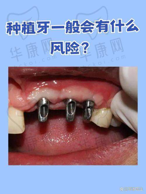 株洲荷塘唯美口腔文华医生团队在以色列雅定种植牙的经验优势
