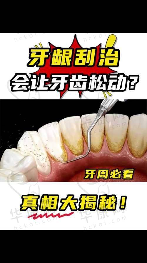 大同平城天使牙博士口腔龈下刮治的成功实例