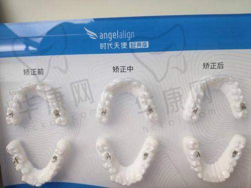 潍坊奎文华贝口腔乔青芳时代天使隐形矫正15700元起，舒适美观矫正优选