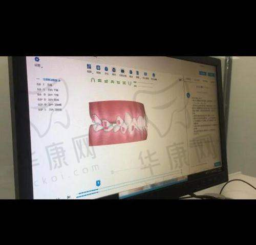 潍坊奎文华贝口腔在时代天使隐形矫正方面的特色优势