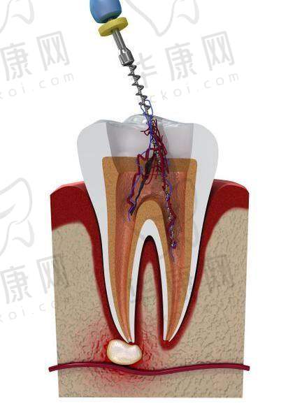 株洲荷塘唯美口腔后磨牙显微根管治疗仅980元起，精准施治守护口腔健康