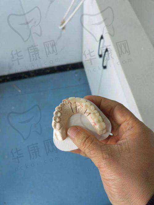 大同平城天使牙博士口腔爱尔全瓷冠1210元起，实惠之选重塑坚固美齿