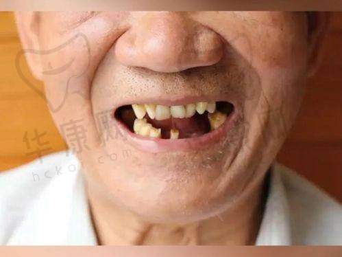 大同平城天使牙博士口腔全口活动义齿的其他优势