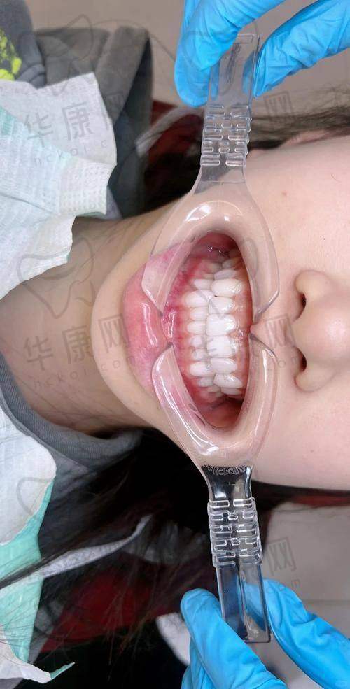 潍坊奎文华贝口腔义获嘉铸瓷贴面注意事项