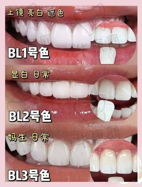 潍坊奎文华贝口腔义获嘉铸瓷贴面仅999元起，品质之选不容错过！