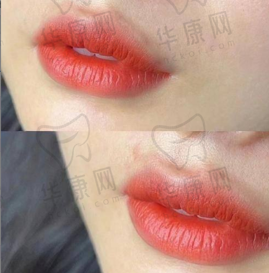 杭州瑞丽医疗美容医院叶盛波腰腹吸脂12000元起，精细操作打造平滑紧致腰腹