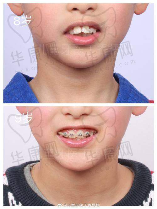 南宁怡友中海口腔在青少年早期矫正方面的特色优势