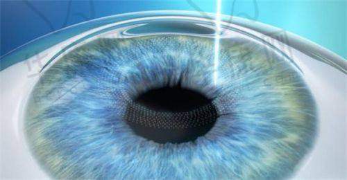 浙大二院近视手术费用新版 2025,术后护理要注意什么?