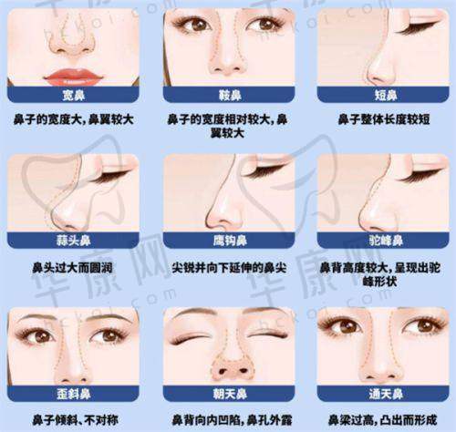 杭州美莱医疗美容医院谭章梅高难眼修复之手术过程