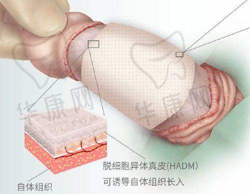 济南美莲整形做鼻子的技术优势