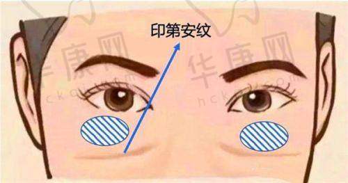 广州健丽医美去眼袋价格贵吗