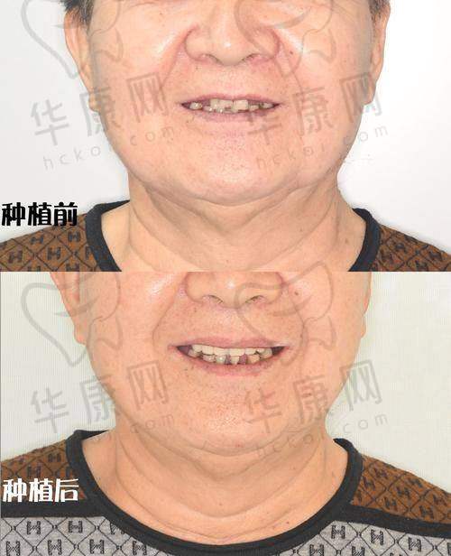 慈溪博瓦口腔曹江平all-on-4半口种植之初次就诊