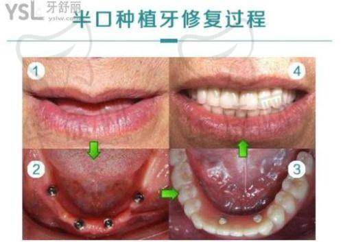 慈溪博瓦口腔曹江平all-on-4半口种植之诊疗成效