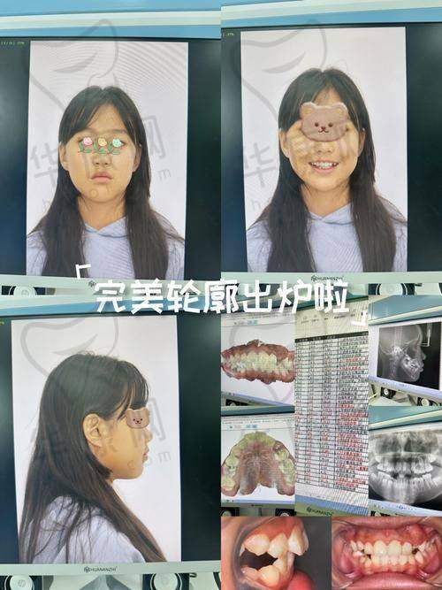 忻州恒伦口腔儿童矫正3000元起，新技术定制方案助孩子口腔健康发育