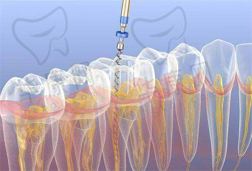达州医大口腔医院根管治疗之治疗过程体验