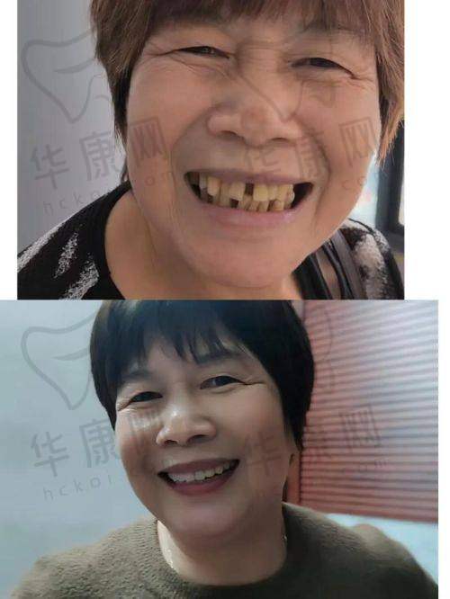 湖南湘西口腔医院何春秀全口即刻种植牙之诊疗成效
