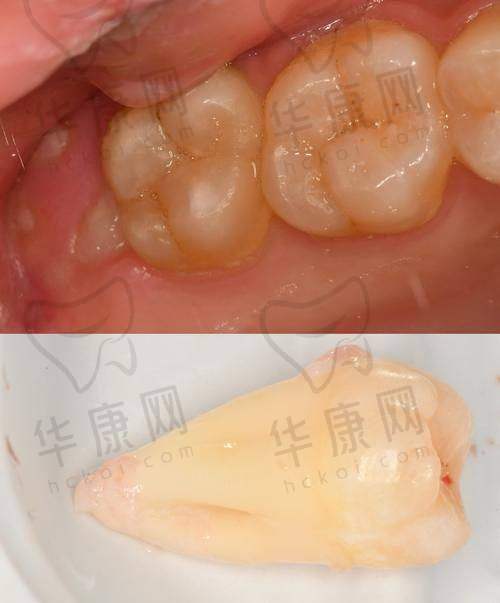 广元中舰口腔下颌正位智齿拔除800元起，技术娴熟拔牙快且痛感轻超省心