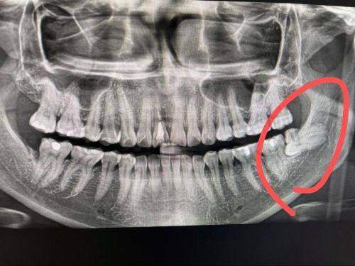 江宁牙管家口腔阻生智齿拔除的口碑优势