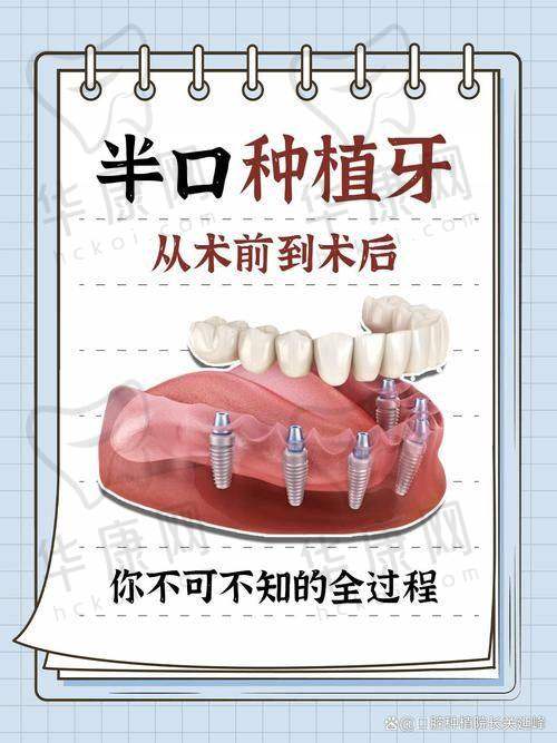 内蒙呼和浩特天牙口腔祝昂明all-on-4半口种植之术前准备