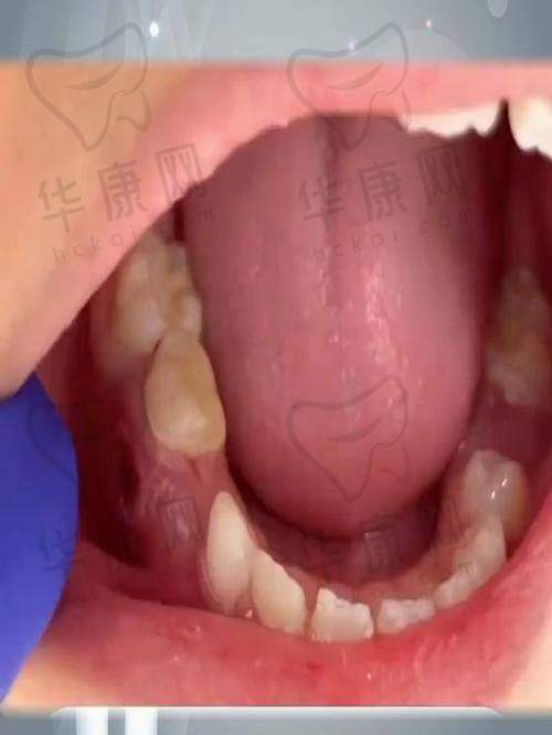 株洲荷塘唯美口腔乳牙拔除体验超棒，解决孩子换牙难题还收获贴心服务