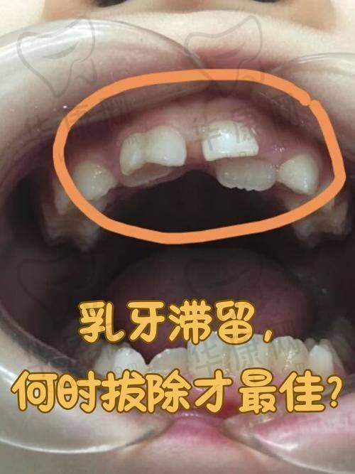 株洲荷塘唯美口腔乳牙拔除之问诊过程