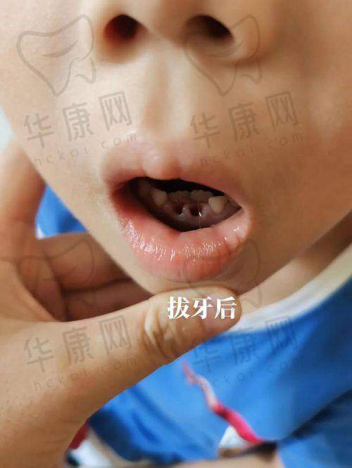 株洲荷塘唯美口腔乳牙拔除之拔牙进行时
